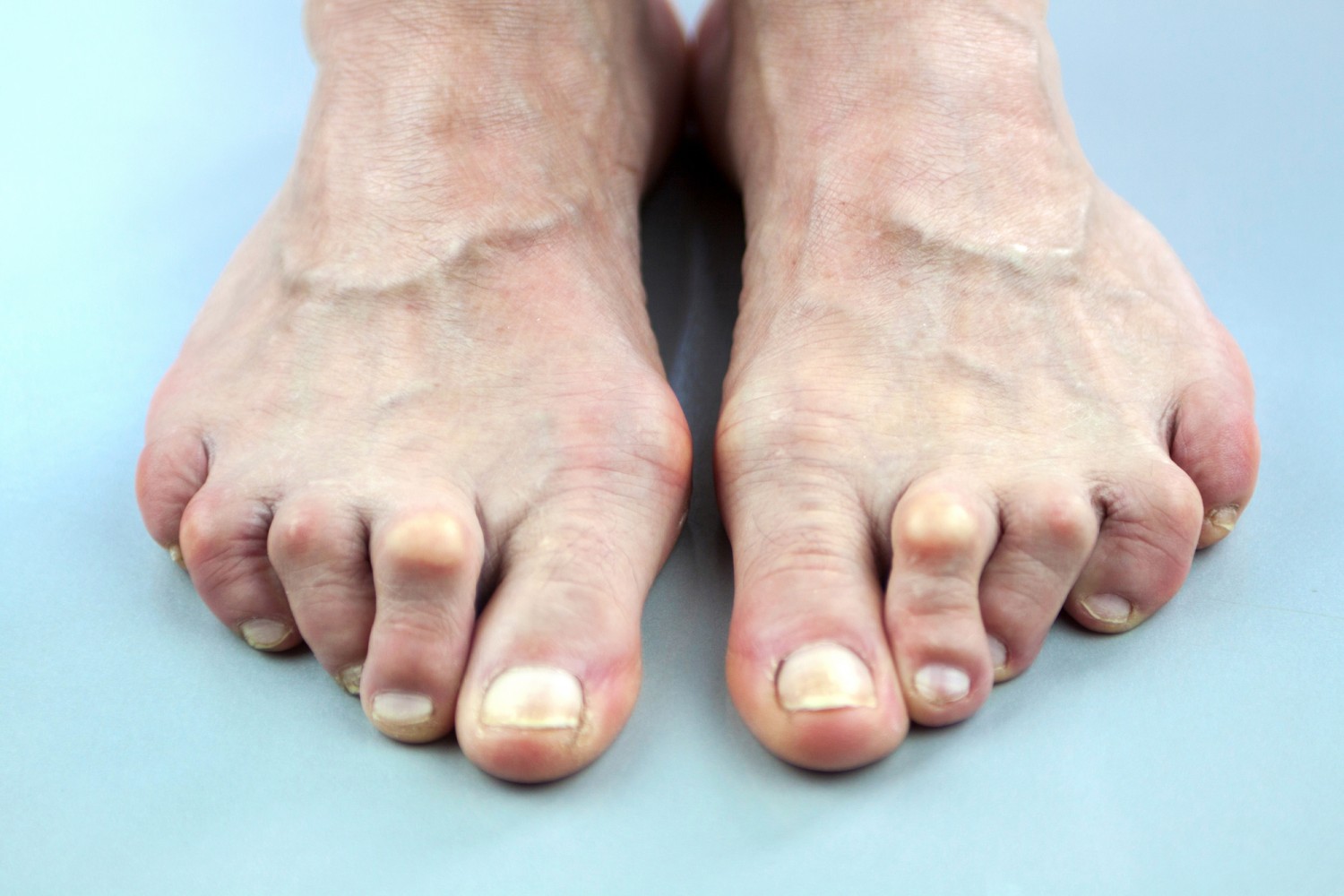 Feet Of Woman Deformed From Rheumatoid Arthritis Hanssen Footcare